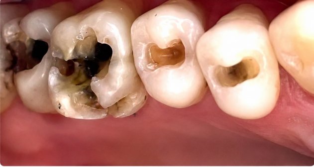 Antes — Restauración por caries