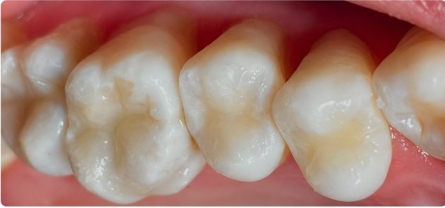 Después — Restauración por caries